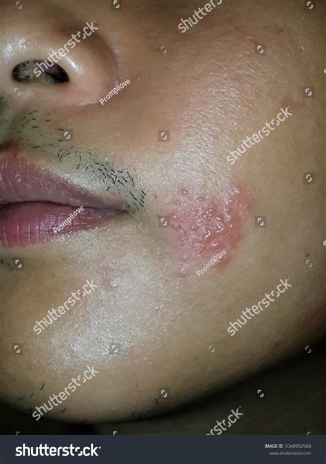 Herpes Zoster On Face