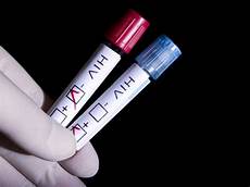 test per l hiv news dal 3th inter workshop on hiv hepatitis coinfection test per l hiv news dal 3th inter workshop on hiv hepatitis coinfection