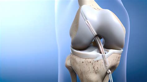 Anterior Cruciate Ligament Reconstruction Surgery