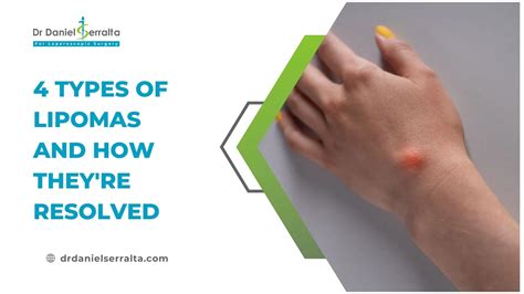 What To Expect After Lipoma Removal Surgery? - Dr. Daniel Serralta