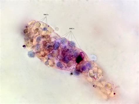 Urine Sediment of the Month: Mixed Cellular Casts - Renal Fellow Network