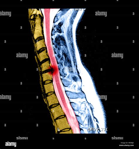 Mri of a cervical herniated disc hi-res stock photography and images - Alamy