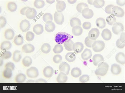 Malaria Parasite Smear