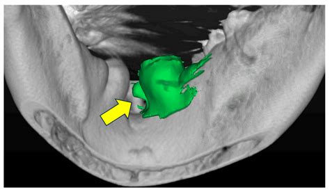 Computed Tomographic Analysis of Mandibular Tori and Their Relationship to Remaining Teeth