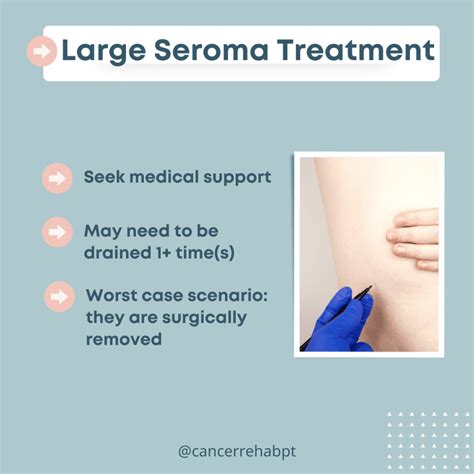 Seroma After Surgery: What It Is & What to Do - Cancer Rehab PT