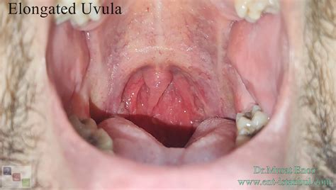 Elongated (Long) Uvula Causes, Symptoms and Treatment