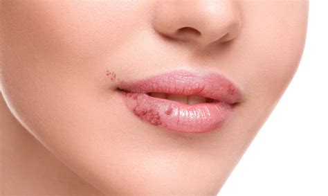 ¿Cómo eliminar un herpes labial de forma casera? - Saludyamistad.com