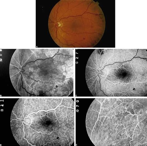 Ocular Ischemic Syndrome