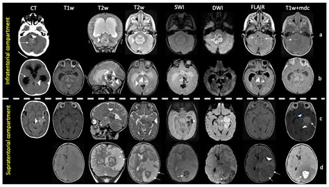 Atypical Teratoid Rhabdoid Tumor: Proposal of a Diagnostic Pathway Based on Clinical Features ...