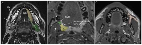 Techniques, Tricks, and Stratagems of Oral Cavity Computed Tomography ...