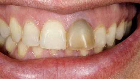 Image result for Stumpy Black Teeth