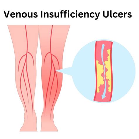 Exploring Remedies for Venous Insufficiency Ulcers - Elite Vascular & Wellness | New Jersey's ...