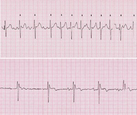 Image result for Synchronized Cardioversion for AFib