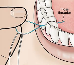 Image result for Using a Floss Threader