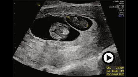 Vanishing Twin Syndrome