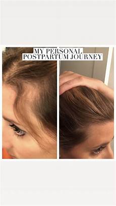 Baby Hair Loss After 6 Months by Hair Loss Monat Fixes Hair Loss After A Baby Baby Hair Loss After 6 Months