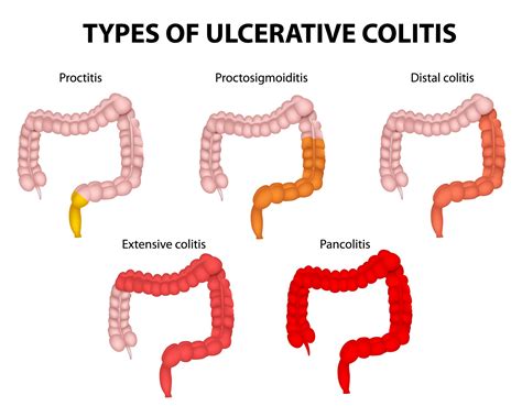 Ulcerative Colitis | Colon & Rectal Surgical Specialists