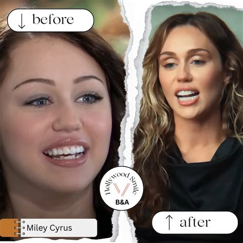 Celebrities Smile Makeovers (Hollywood Smile) Before and After