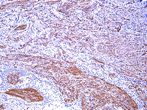 Dermatopathology Society of India: Image of the Month