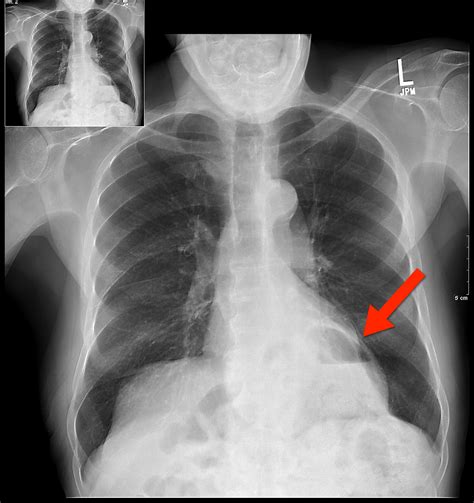 Hiatus Hernia | Hong-kong | PDF | PPT| Case Reports | Symptoms | Treatment