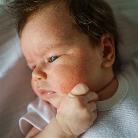 Clinical Points in the Diagnosis and Management of Chronic Urticaria