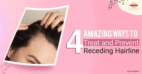 Receding Hairline Treatment: 4 Ways to Treat Receding Hairline
