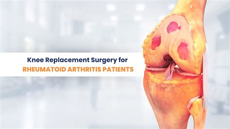 Knee Replacement Surgery Cost in Hyderabad - Wellness Hospitals