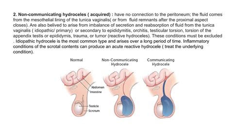 Treatment For Communicating Hydrocele