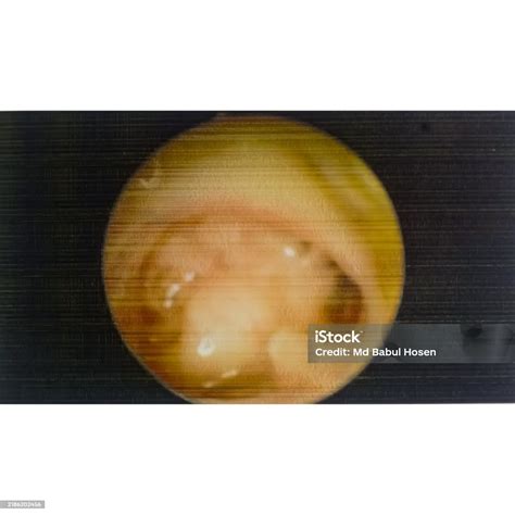 Ear Endoscopy Chronic Suppurative Otitis Media Subtotal Perforation Of The Tympanic Membrane ...