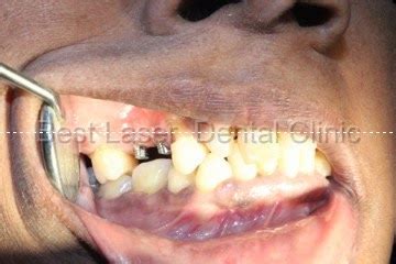 » Removable partial denture replaced with dental implants