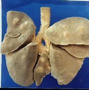 肺吸虫病 的图像结果