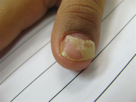 Paediatric Infectious Disease: Onychomadesis: A common sequalae and ...