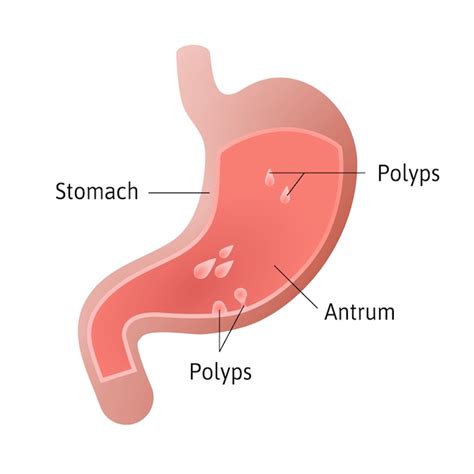 Polip Gaster - patofisiologi, diagnosis, penatalaksanaan - Alomedika