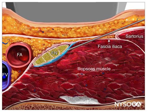 Genitofemoral Nerve Block Ultrasound