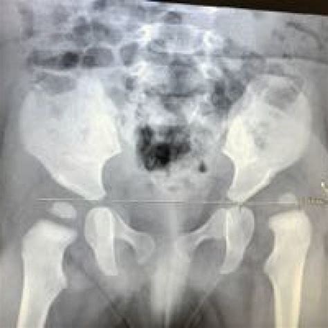 La displasia de cadera. Comienzan las preocupaciones. | Traumatólogo ...