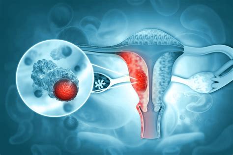 25 Facts About Endometrial Cancer (Uterine Cancer) - Facts.net