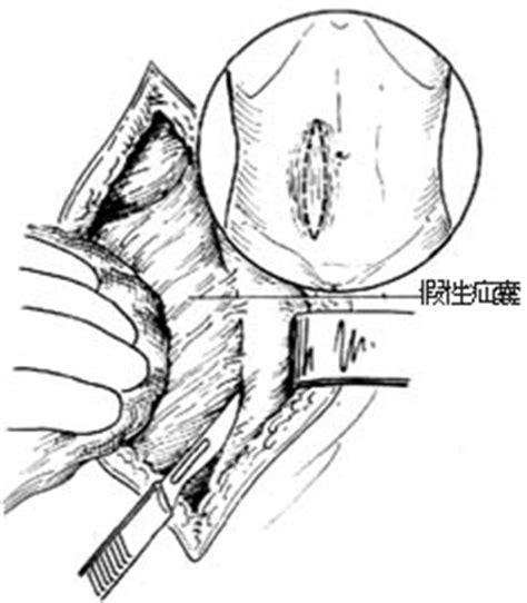 腹壁切口疝修复术全过程图解及手术常识 【蜘蛛网:图解手术百科】