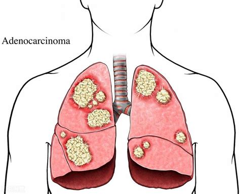 肺病的种类（三种肺癌类型，哪种更难治疗）_环球信息网