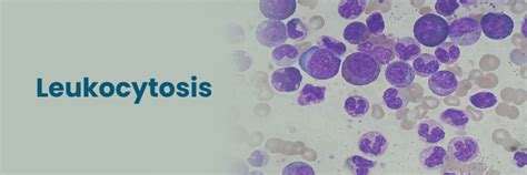 Leukocytosis: Causes, Symptoms, and Treatment Options
