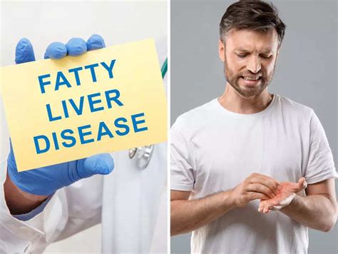 Fatty Liver Symptoms: Beware of the fatty liver disease sign that may ...