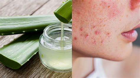 5 Powerful Home Remedies To Say Goodbye To Acne Scars