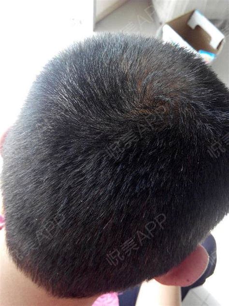 植发大约有140天了，看了下4个月到5个月植发的状态，...头部毛发种植_悦美整形