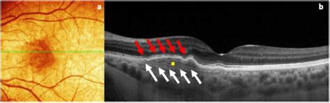 Postpartum Exudation of Idiopathic Quiescent Macular Neovascularization ...