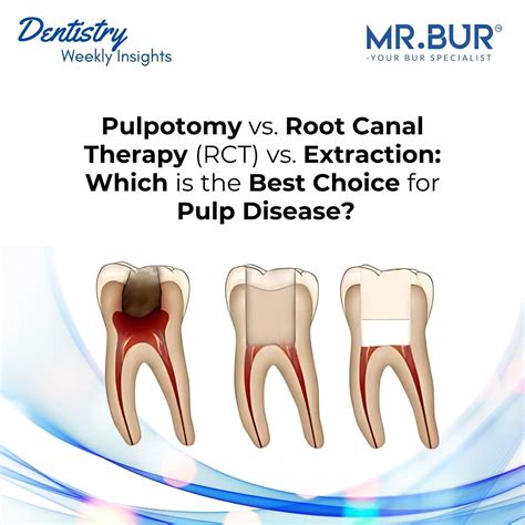 Pulpotomy Pulpotomy Vs Pulpectomy 🦷 Read Our New Blog Post To Learn