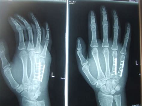 手指骨折做钢板内固定手术后已经5周了 多长时间拆掉外固定石膏啊-右手第五掌骨骨折，做了钢板内固定手术后一个月了，前两天...