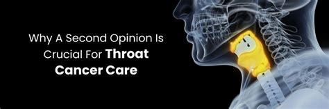 Crucial Second Opinion for Throat Cancer Care