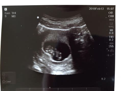 Ultrasound Pictures Week By Week