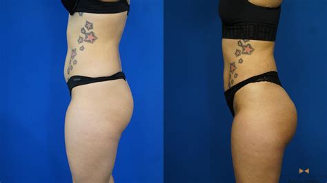 Before And After Brazilian Butt Lift Pics