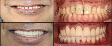 Smile Designing | Aurasmiles Dental clinic |Dentist in Kandivali ...