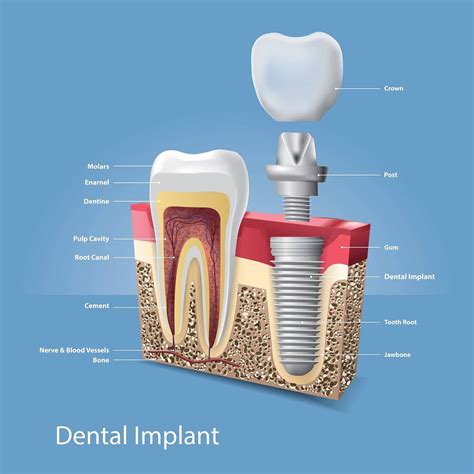 Here’s Why Richmond Hill Patients Prefer Dental Implants